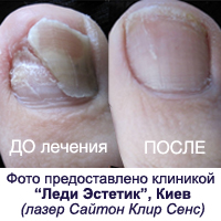 Грибок ногтей можно вылечить без боли и медикаментов!